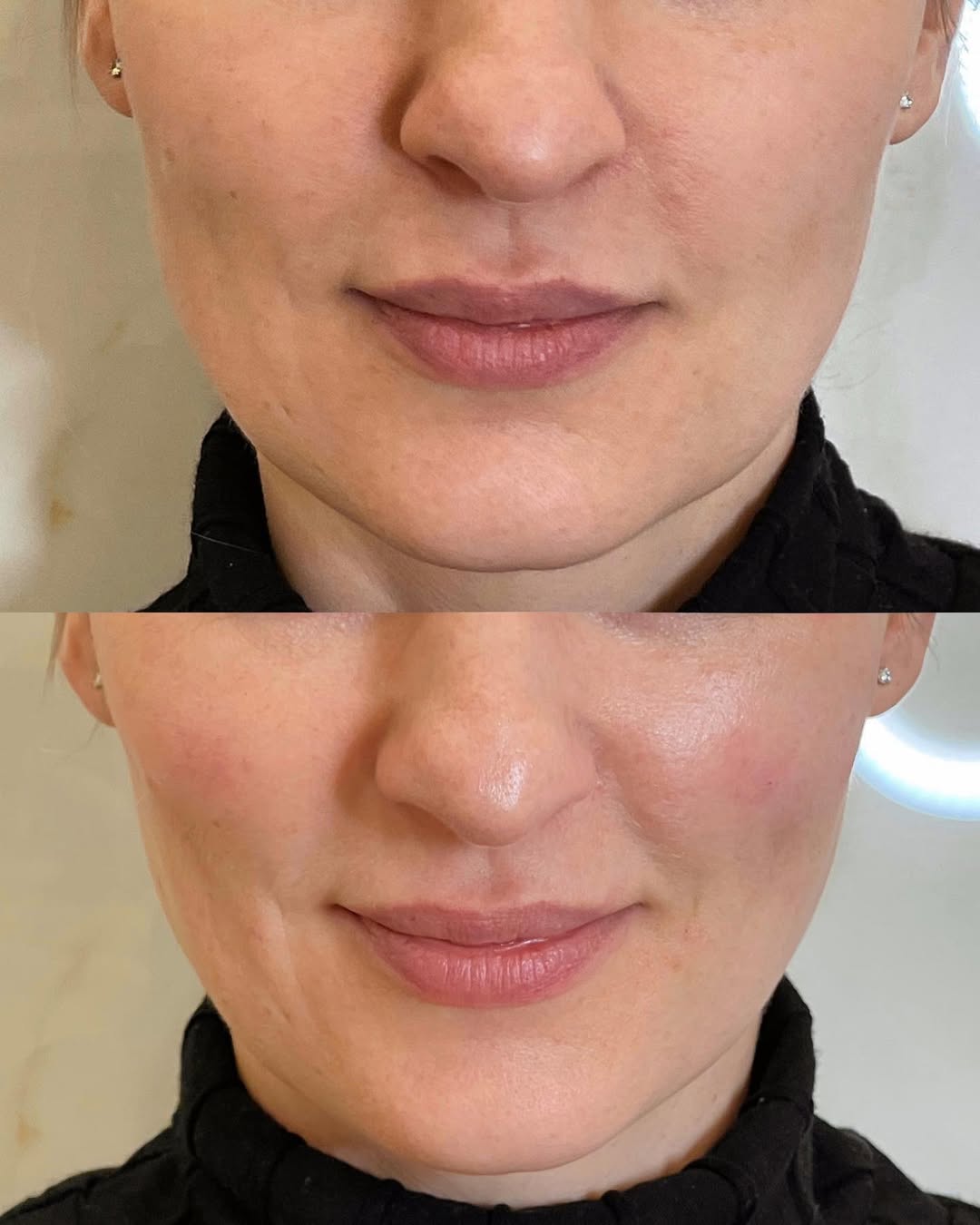 Risultato filler labbra