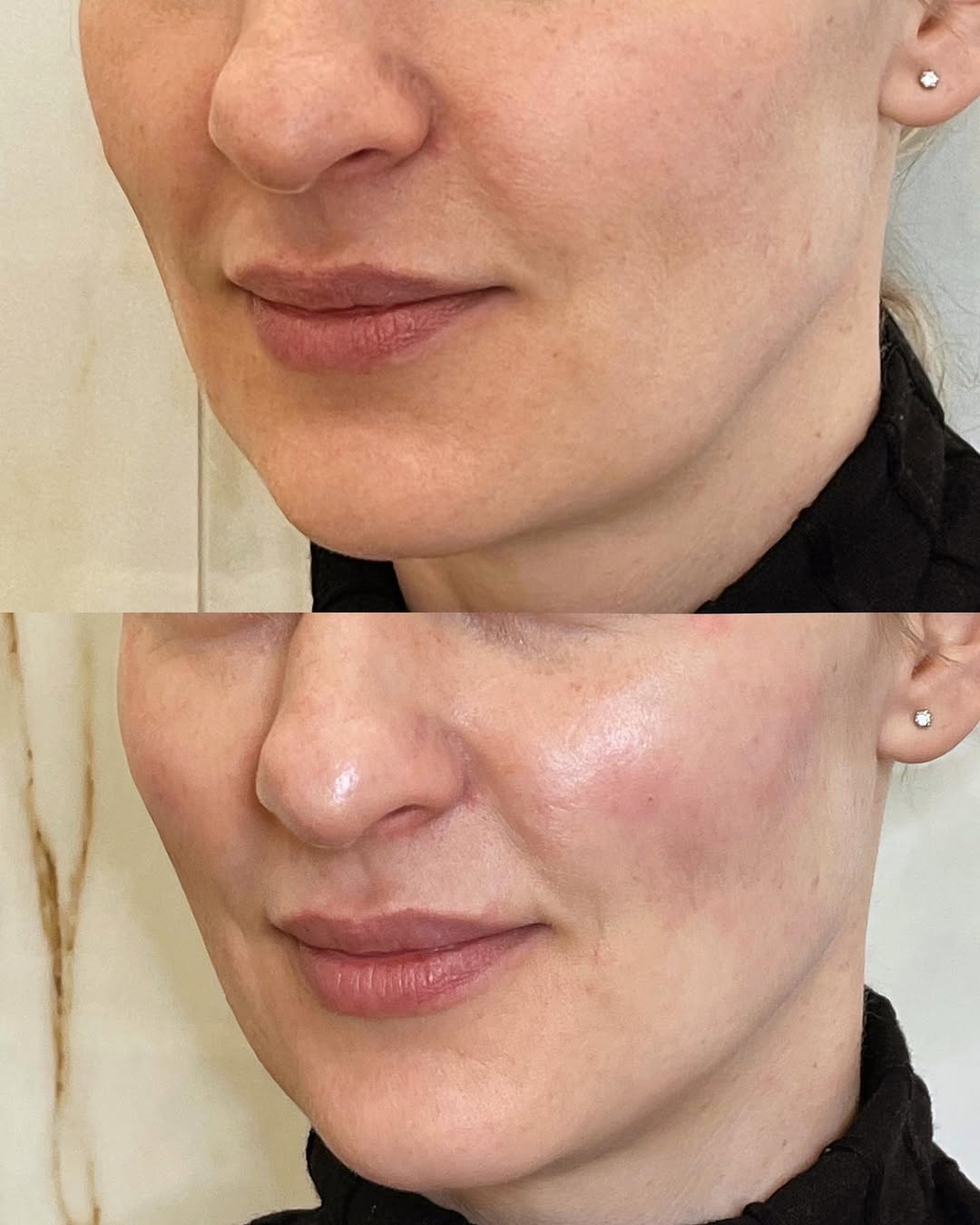 Risultato volumizzazione labbra