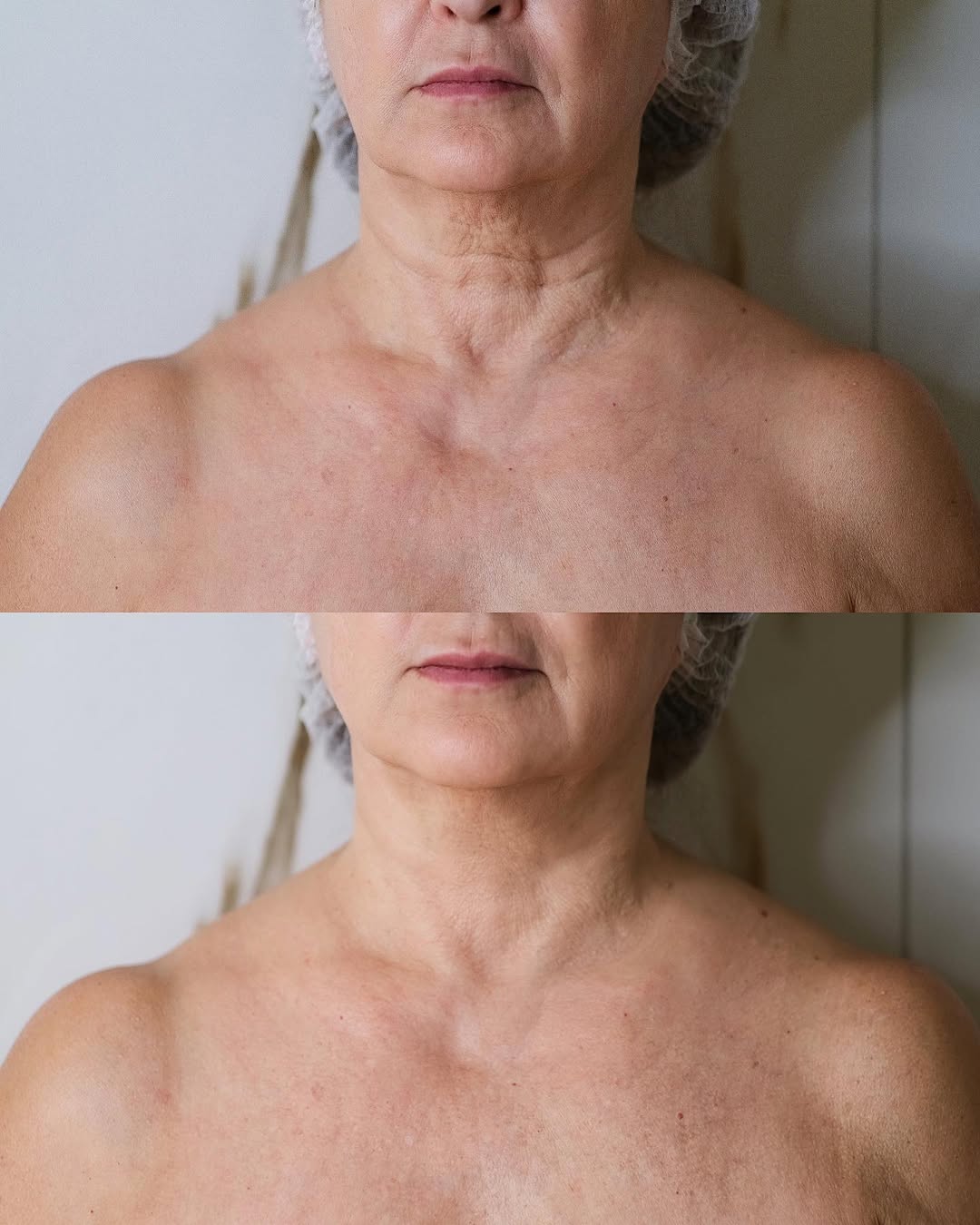 Risultato biostimolazione collo e décolleté
